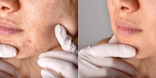 Night Rituals To Follow For Acne Prone Skin - Dr. Shivani
