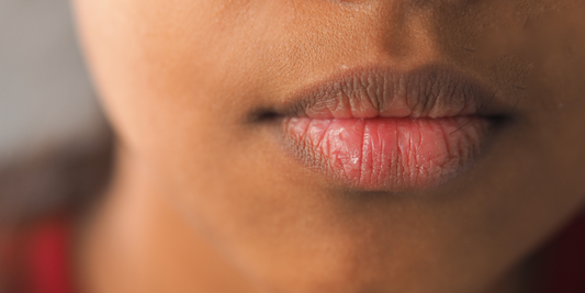 Why Are My Lips Dry and Dark? Causes & Natural Lip Care Guide