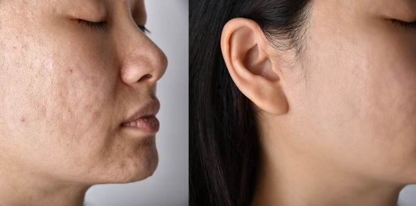 Transformation from Acne and Pigmentation to Clear Skin