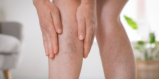 varicose vein