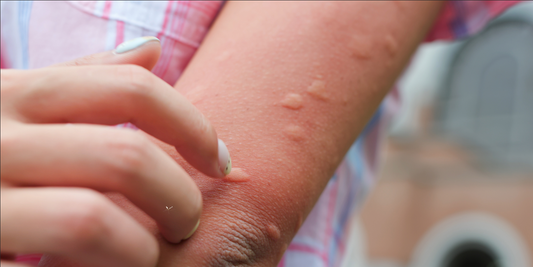 mosquito bites